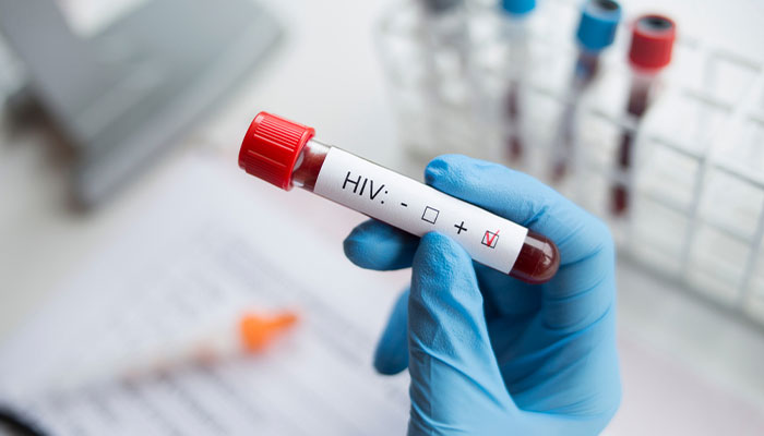 HIV: Nguyên nhân và cách điều trị