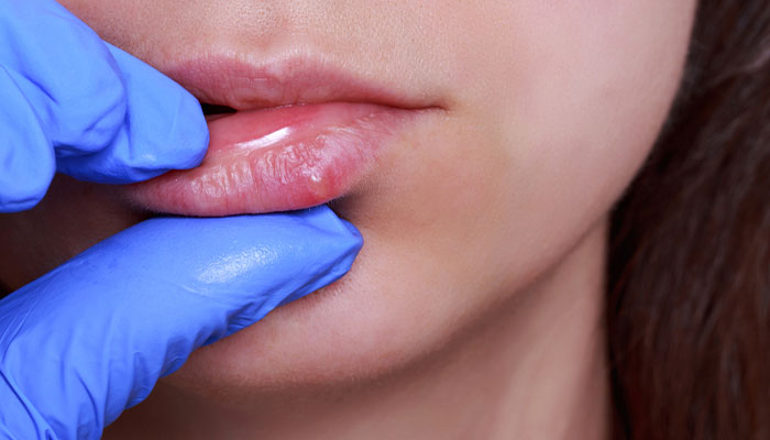 Herpes môi: Nguyên nhân và cách điều trị