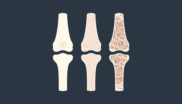 Loãng xương: nguyên nhân và cách điều trị