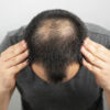Rụng tóc từng mảng: nguyên nhân và cách điều trị